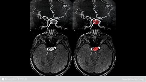 Ano ang Nagdudulot ng Aortic Aneurysms .